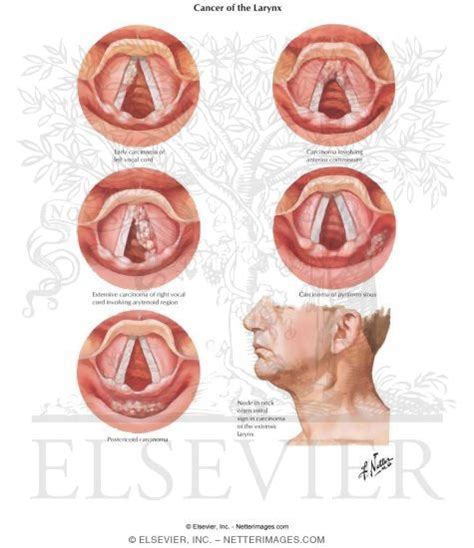 Cancer Of The Larynx