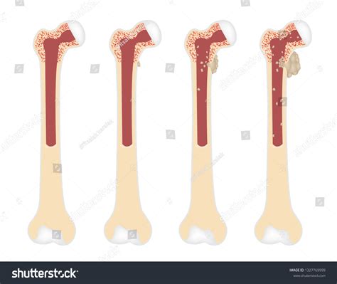 cancer spread bone images stock  vectors shutterstock