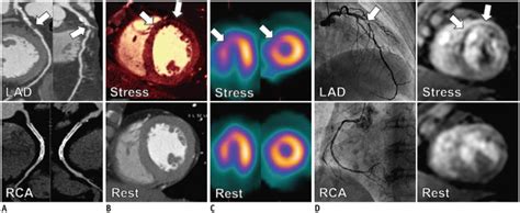 Diagnostic Performance Of Coronary Ct Angiography Stress Dual Energy