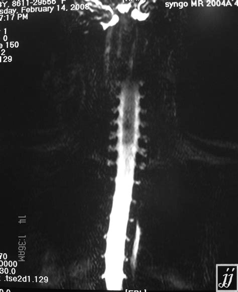 Lateral Meningocele As Variant Radiopaedia