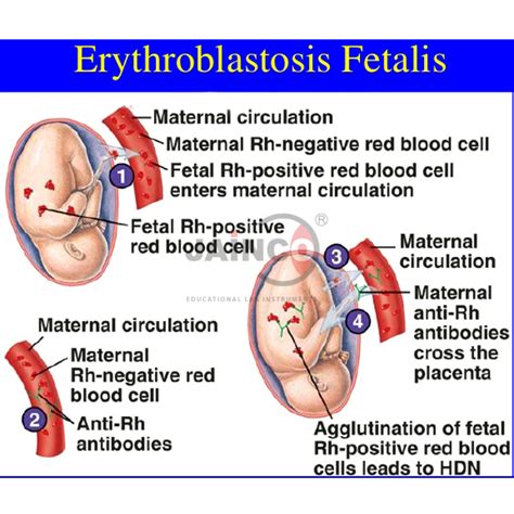 Erythroblastosis Fetalis Anthromania