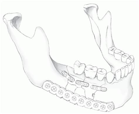 Mandibular Fractures Ento Key