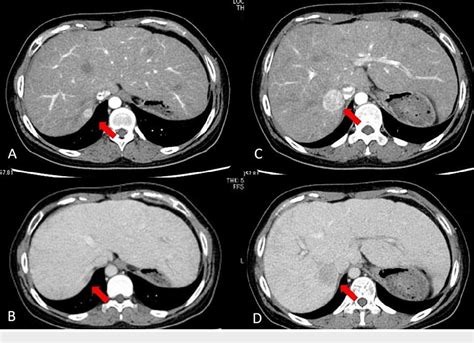 Figure 1 From A Case Of Resection Of Hepatocellular Carcinoma In A Patient With Fontan