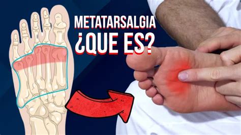 Qué es la metatarsalgia y cuáles son sus causas Clínica Estemedic