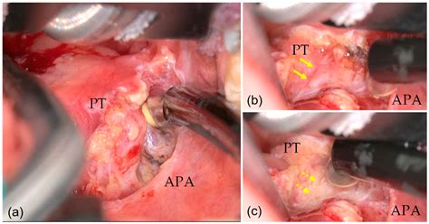 Medicina Free Full Text Improvement Of Surgical View And Working