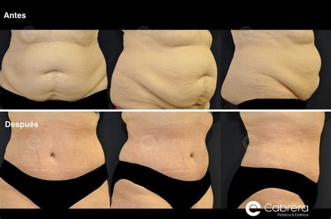 Fotos De Lipoescultura Antes Y Despues Infoupdate Org