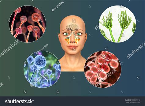 Fungi Cause Sinusitis 3d Illustration Showing Stock Illustration 1950378916