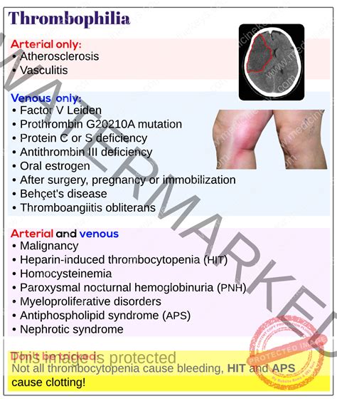 Thrombophilia Clotting Disorders Medicine Keys For MRCPs