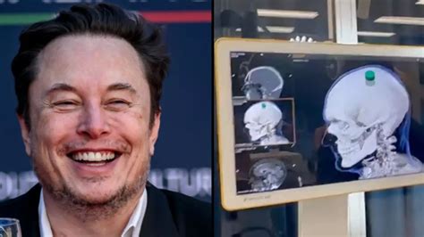 Elon Musk Reveals First Neuralink Brain Chip Has Been Implanted In A Human With Very Specific