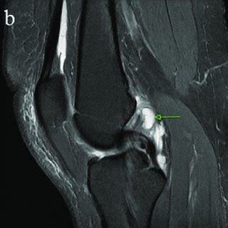 mucoid degeneration of acl treatment - geraldroegner-99