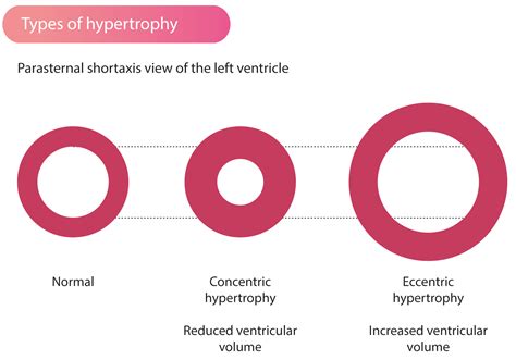 Hypertrophic Cardiomyopathy (HCM) & Hypertrophic Obstructive ...