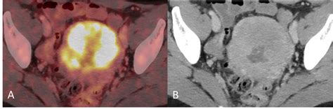 A 57 Year Old Post Menopausal Woman Underwent Gynecological Examination