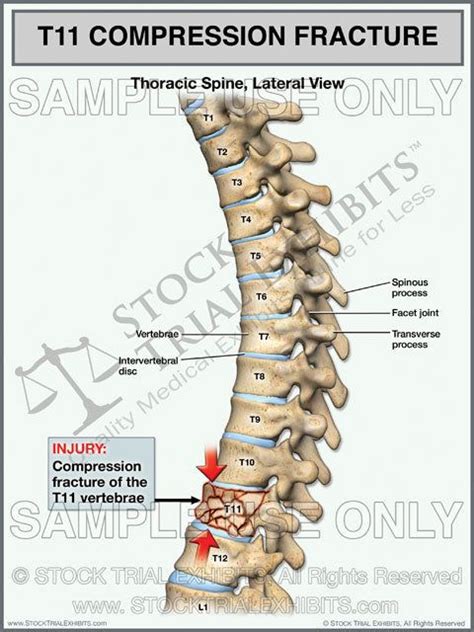 This trial exhibit depicts T11 compression fracture injury of the ...