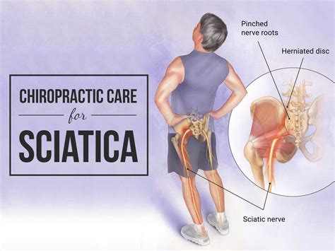 Chiropractic Care For Sciatica