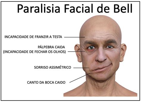O Que É Paralisia De Bel - Paralisia de Bell (Paralisia Facial) - Medicina de Excelência