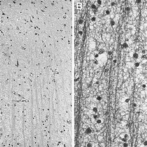 A Normal Neuropil In Frontal Cortex Contrasts With Diffuse Fine