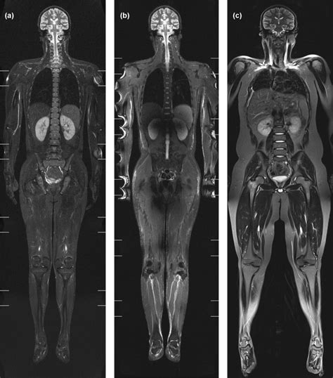 Whole Body MRI Of Neuroblastoma European Journal Of Radiology