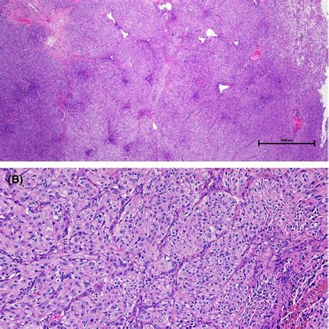 Hematoxylin‐and‐eosinstained Histologic Sections Of Excised Specimen