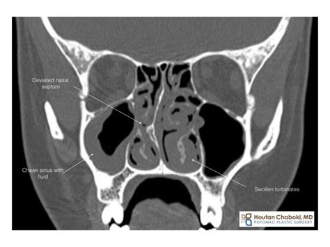 Turbinoplasty: Reducing nasal turbinates to improve breathing in ...