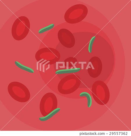 Bloodstream With Bacteria Sepsis Stock Illustration 29557362 PIXTA