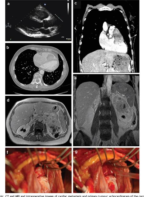 Figure 1 From Right Ventricular Metastasis Of Transitional Cell Carcinoma Of The Renal Pelvis