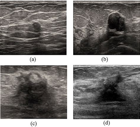 The Breast Ultrasound Tumor Samples Used In This Article A And B