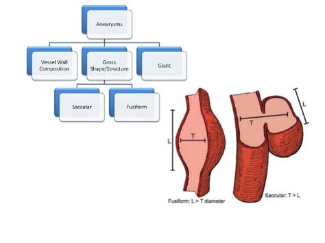 Coronary Artery Aneurysms and Ectasia