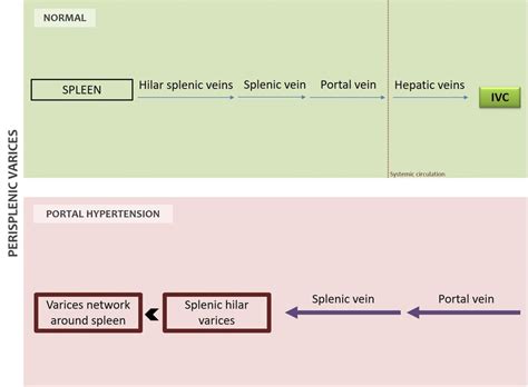 Didactic Scheme From Perisplenic Varices Development Blue Arrows