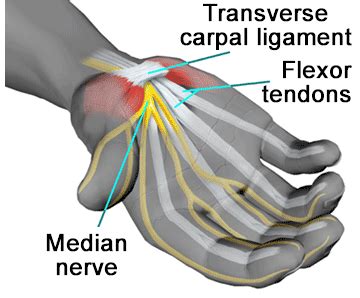 Carpal Tunnel Syndrome Treatment In Denver Chiropractic Clinic