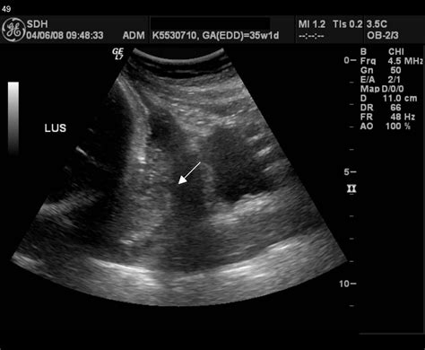 Haemorrhage Antepartum