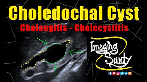 Choledochal Cyst With Cholangitis And Cholecystitis Ultrasound Case 272 Youtube