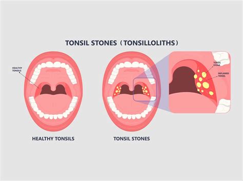 Tonsils