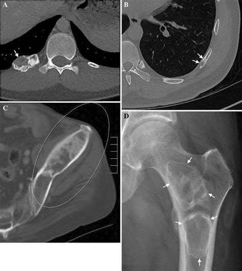 Fibrous Dysplasia Examples Expansile Well Defined Lesion With