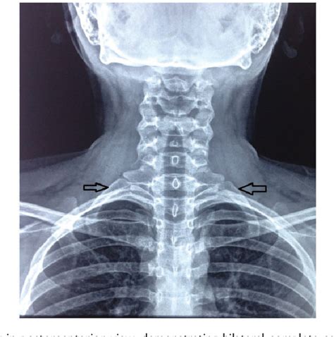 Figure 1 From Bilateral Complete Bony Cervical Ribs Semantic Scholar