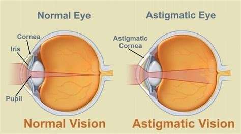 Blurred Vision - Causes, Symptoms And Natural Treatment! - Veledora health