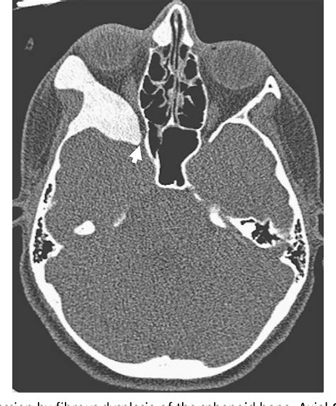 Fibrous Dysplasia Of The Sphenoid And Skull Base Semantic Scholar