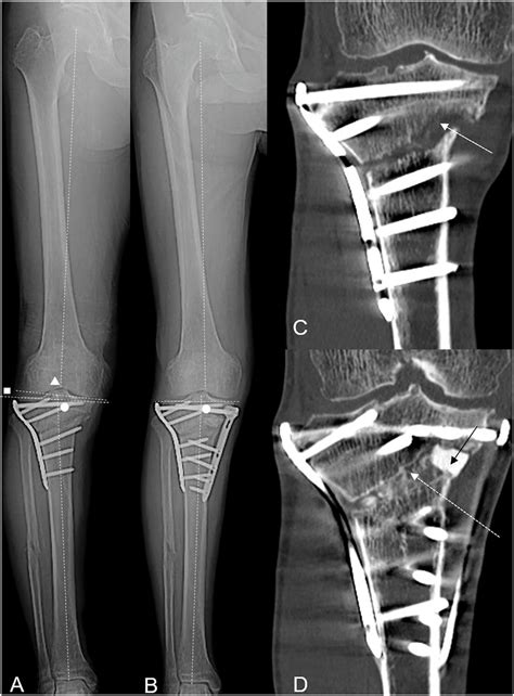 Re Correction Hto Case In Table A Full Length Anteroposterior