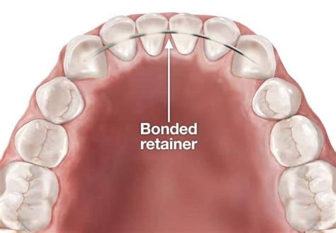 What Are Permanent Retainers And How Do They Work — Orthodontic