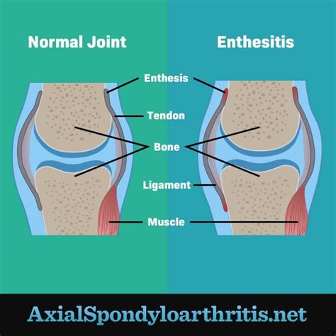 Body Pain and Axial Spondyloarthritis