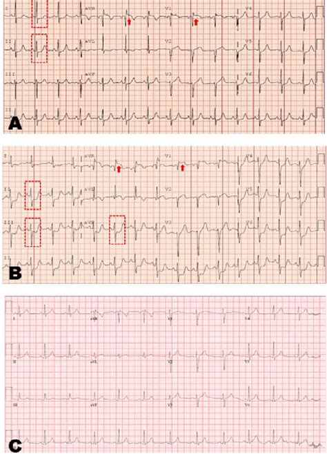 A Initial Electrocardiogram Ecg Showing Mv St Elevations In Avr