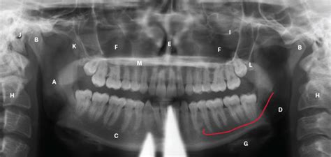 Radiology - OPG and Intraoral Films Flashcards | Quizlet