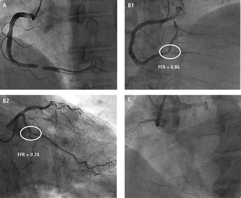 Management Of Coronary Chronic Total Occlusion Cleveland Clinic