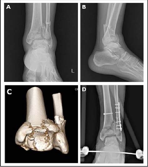 Figure 1 From Treatment Of Aoota Type C Pilon Fractures Through The