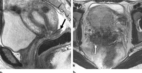 Posterior Neofornix Of The Vagina A Sagittal T2 Weighted Image Shows