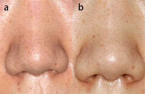 Laser Skin Resurfacing Pores