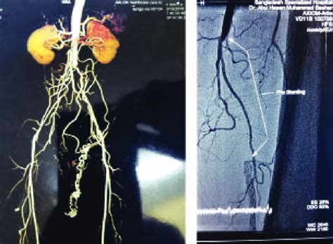 A Computed Tomographic Angiogram Cta Showing Aorto Iliac Occlusion Download Scientific