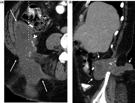 A 49 Year Old Woman With Complicated Appendiceal Mucinous Download