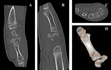 Preoperative CT Scan Two Lateral Views A And B Axial View C And