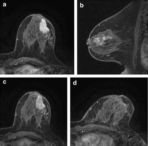 Her Breast Cancer Of Left Breast In Year Old Woman Prior To Nac