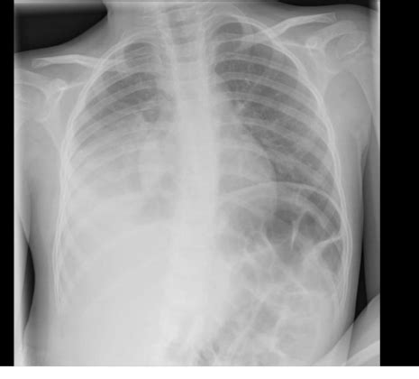 Chest Xray Images Flashcards Quizlet